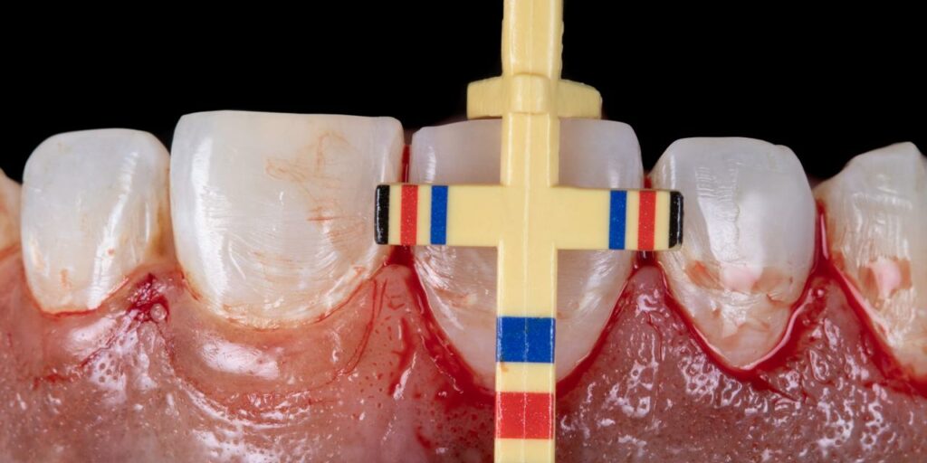 Curso Cirurgia Gengival